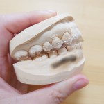 顎関節症・歯ぎしり対策マウスピース